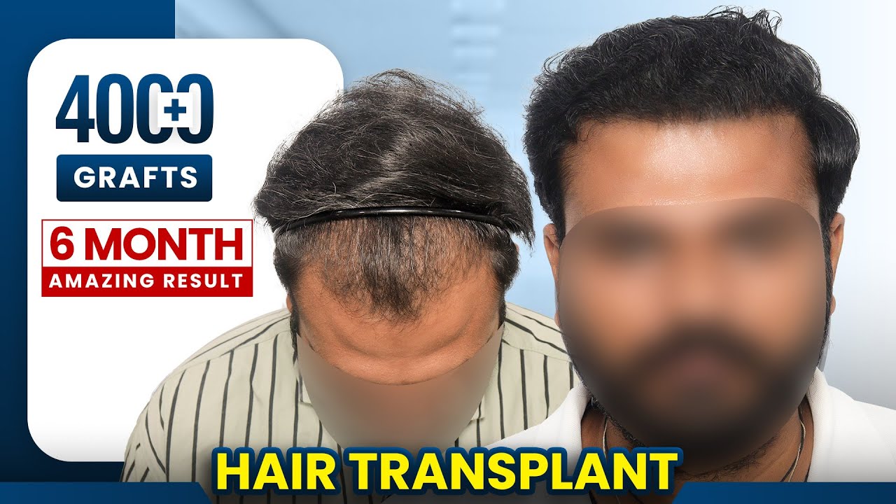 4000+ Grafts Hair Transplant in Surat | Amazing Results & Affordable Cost in Surat #hairtransplant
