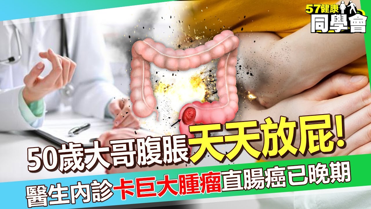 50歲大哥腹脹「天天放屁」外漏咖啡色液體！醫生從屁股內診10公分「卡巨大腫瘤」直腸癌已晚期？！【 @57healthy  】#柯世祐 醫師