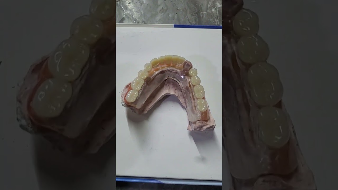Simulación doble inyección de prótesis dentales 