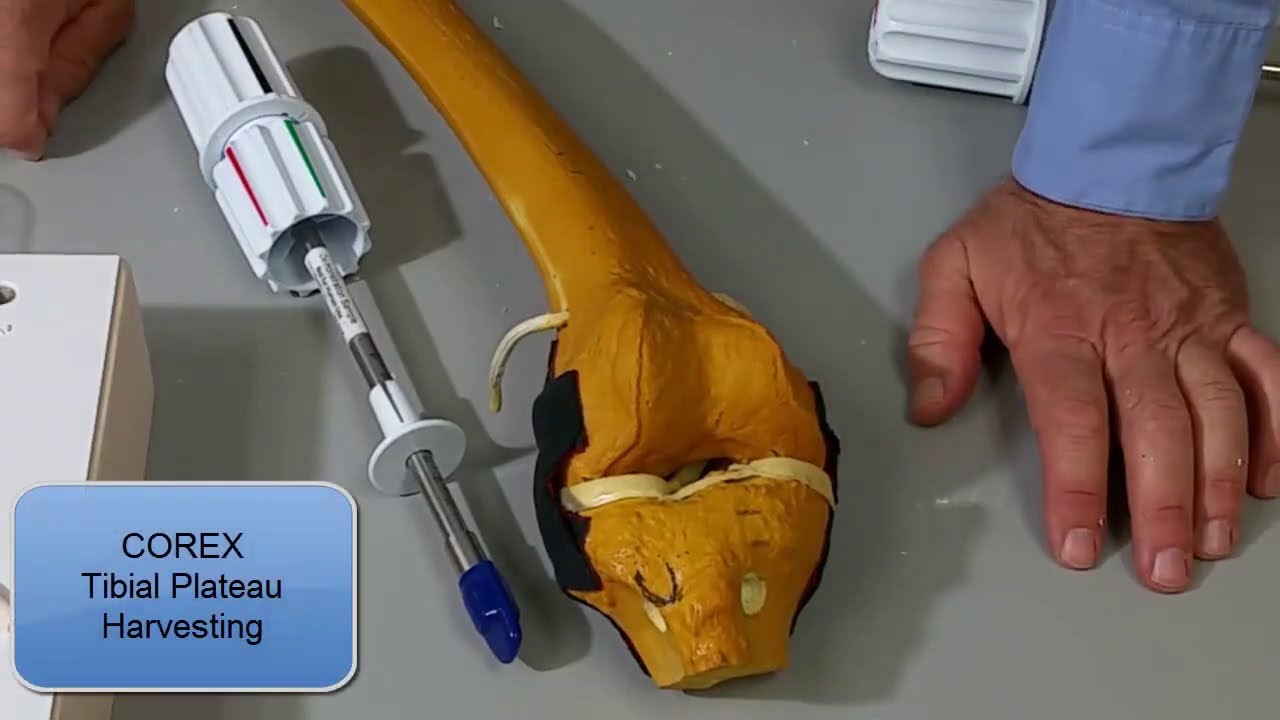 COREX&trade; | Proximal Tibia Bone Graft Harvest - Approach
