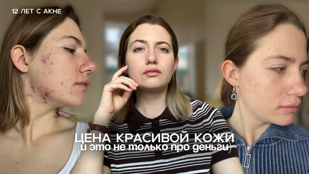 акнекутан || стоит ли того | результат терапии | побочки