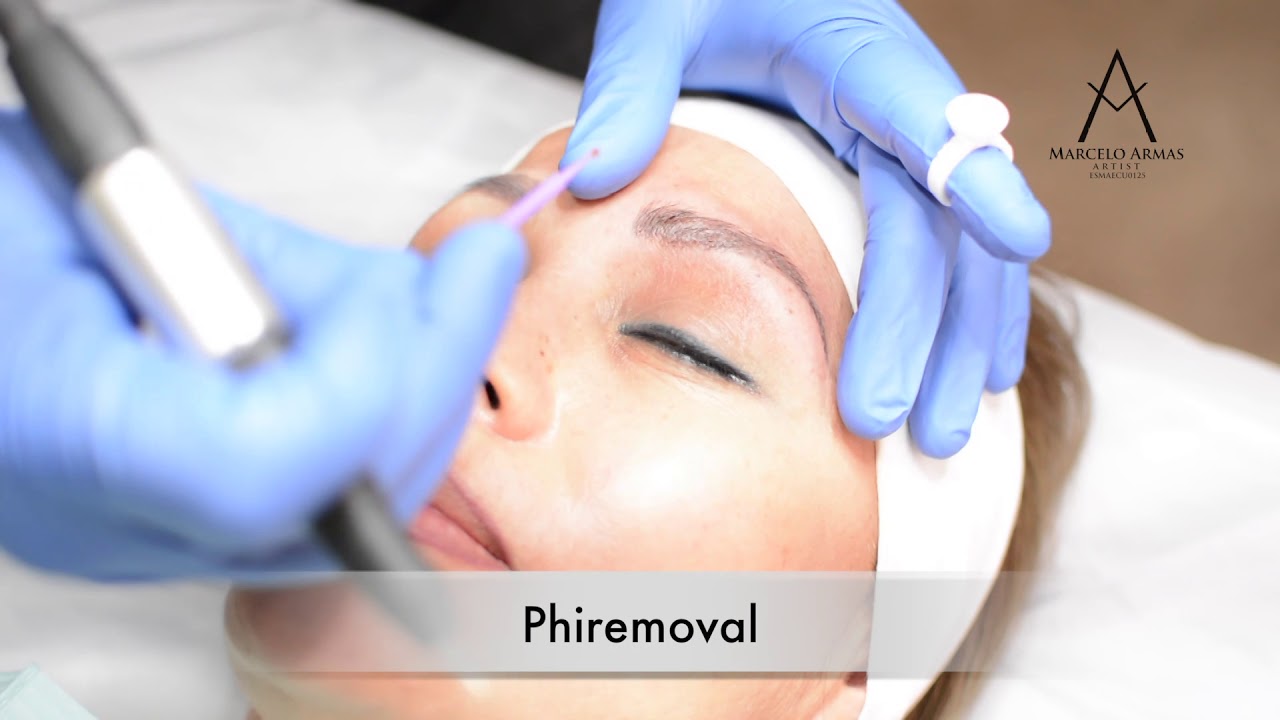 REMOCIÓN DE TATUAJES TÉCNICA PHIREMOVAL