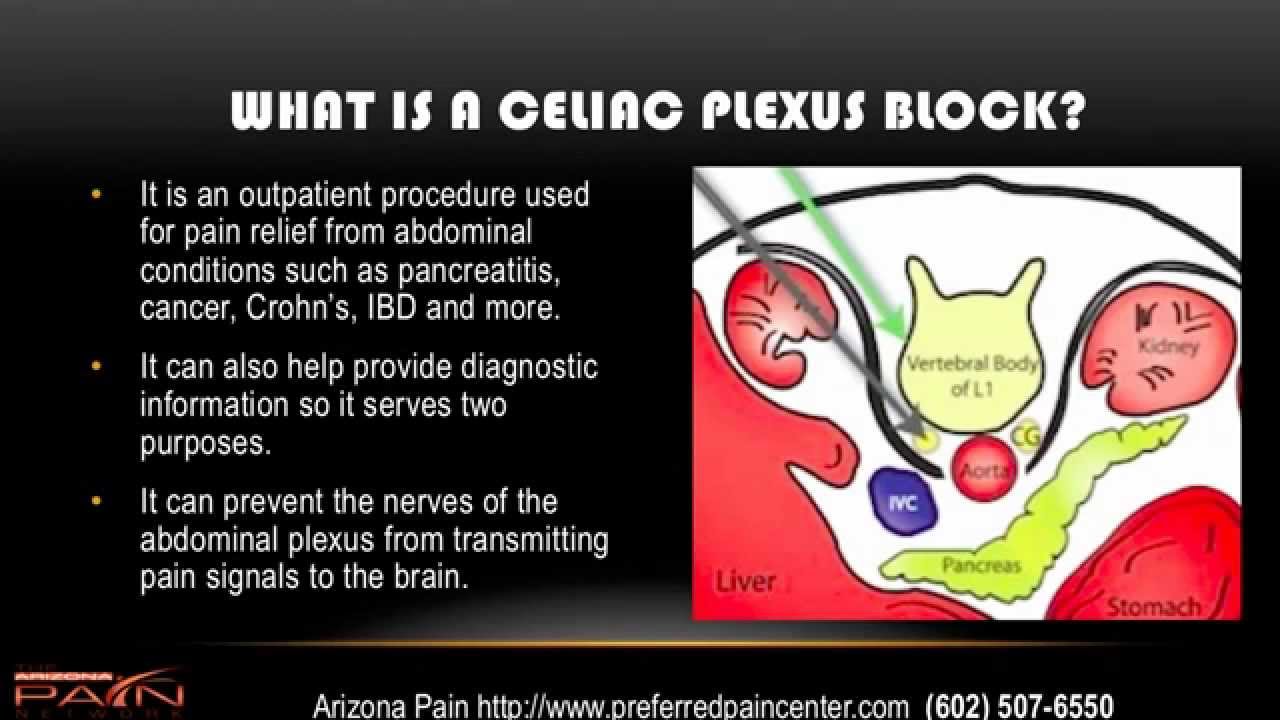 Celiac Plexus Block for Abdominal Pain Explained (602) 507-6550