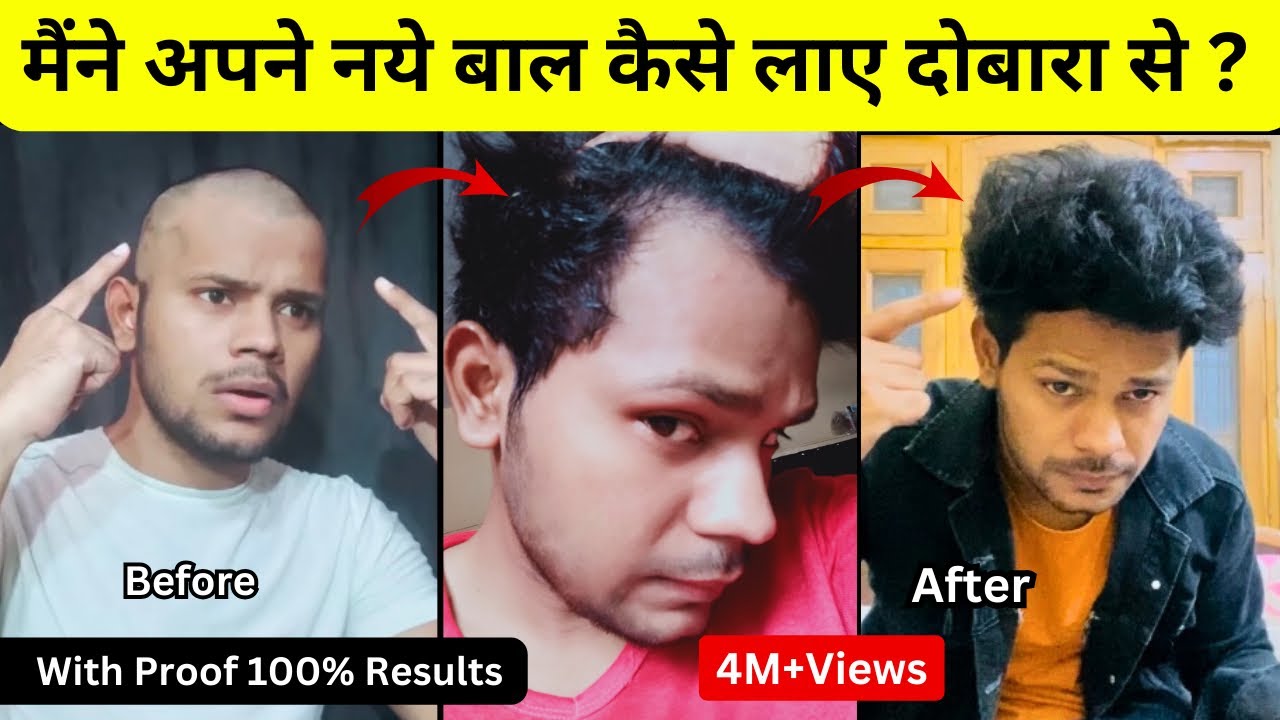 Как я отрастил волосы | Моя реальная история о выпадении и восстановлении волос | С доказательств...