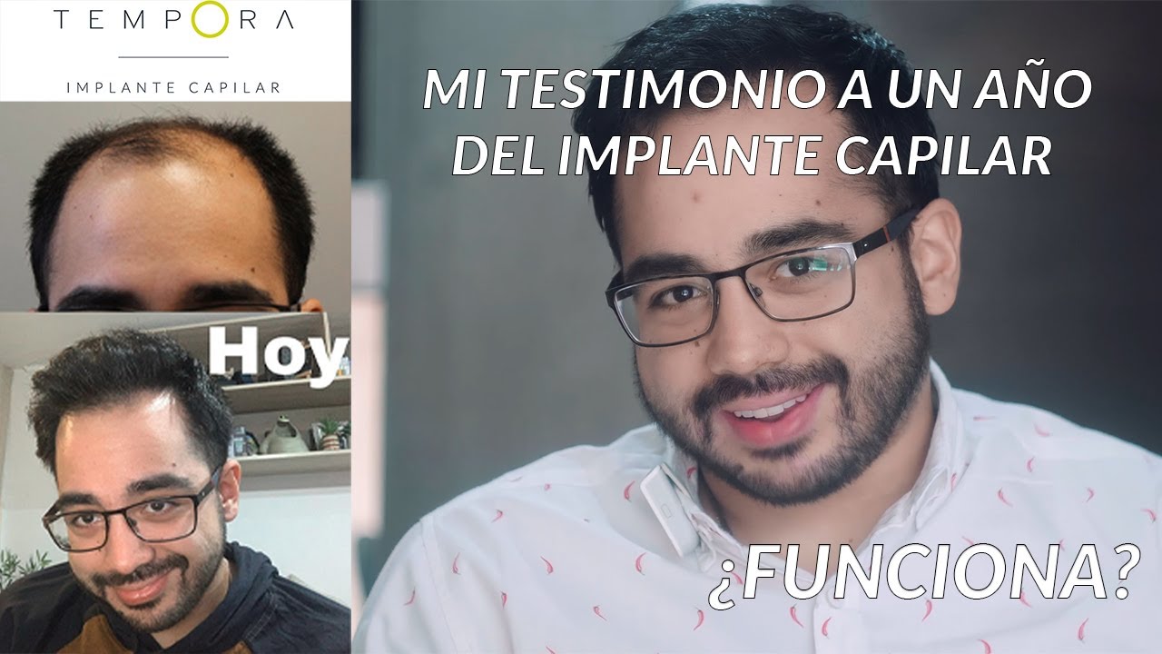 Testimonio Implante Capilar - Clínica Témpora - Chlie