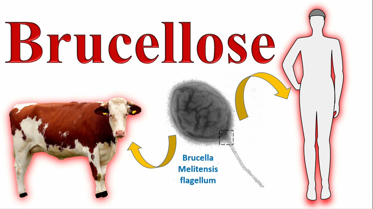 Brucellose Humaine animalebovine Fièvre de malte transmission risques consommation lait de vache cru