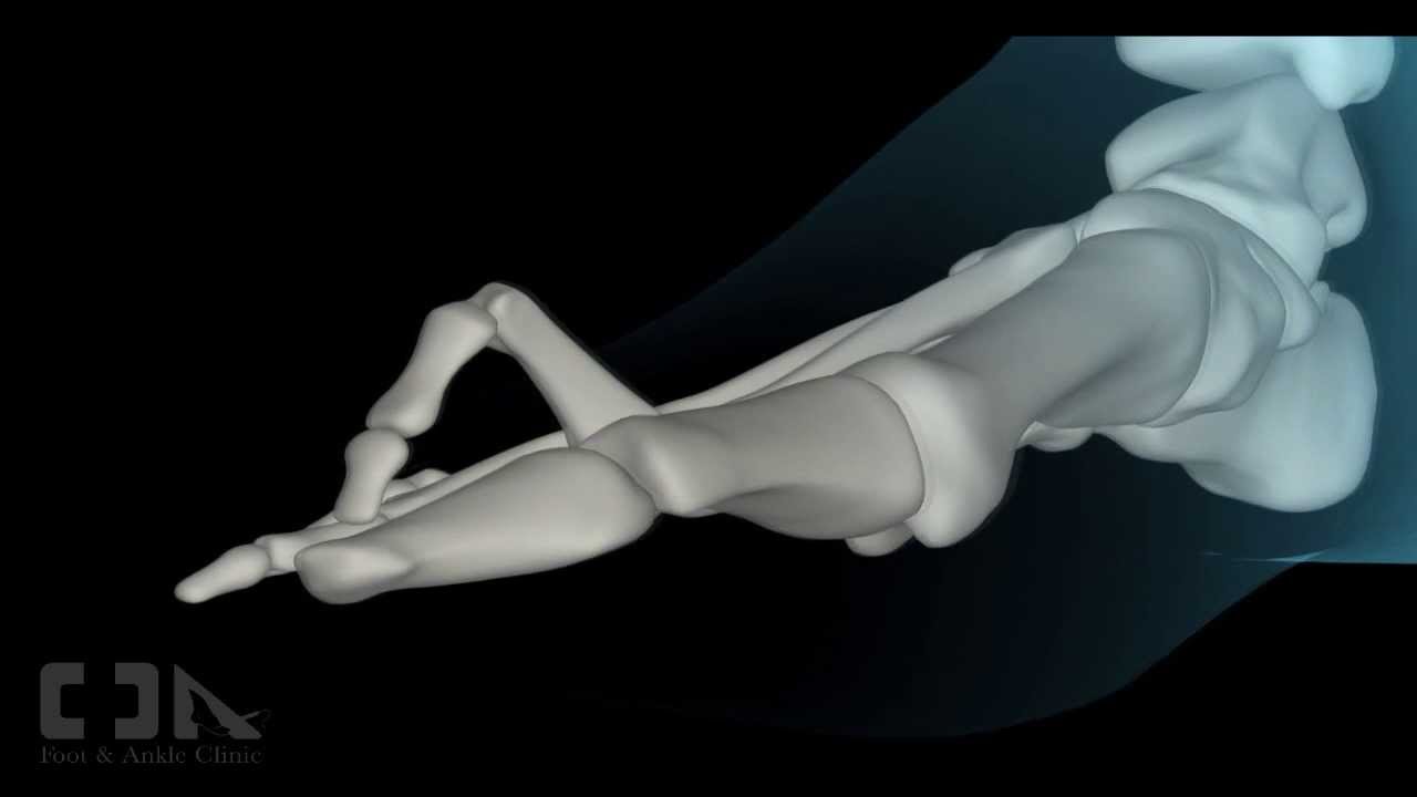 Minimally Invasive Flexible Hammertoe Surgery