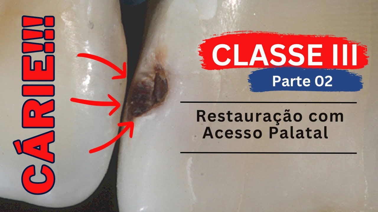 Restauração Classe III - Parte 02 - Acesso Palatal