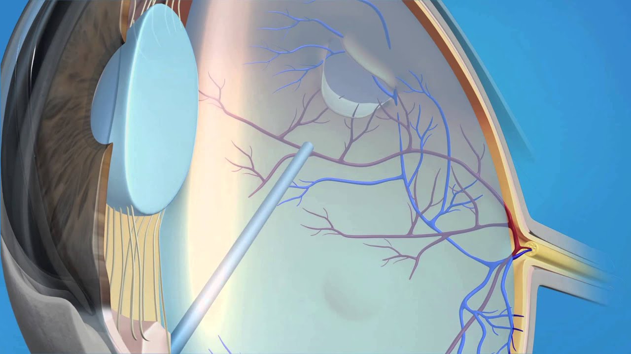 Detached Vitrectomy Scleral Buckle by Retina Consultants of Southern California