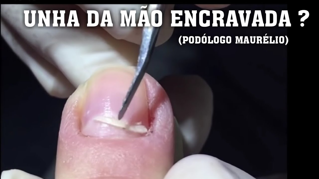 COMO DESENCRAVAR A UNHA DA M&Atilde;O 🤚 SEM DOR (HOW TO UNCLOG FINGERNAIL WITH NO PAIN) - POD&Oacute;LOGO MAUR&Eacute;LIO