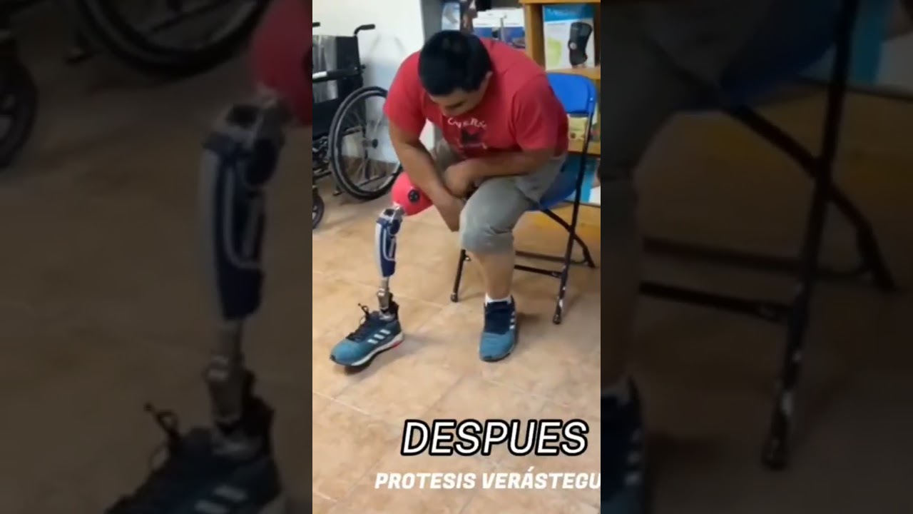 antes y despu&eacute;s de una pr&oacute;tesis transfemoral #amputados #pr&oacute;tesis
