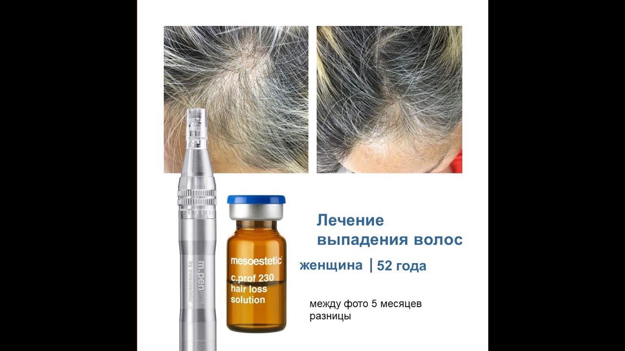 Фракционная мезотерапия Mesoestetic