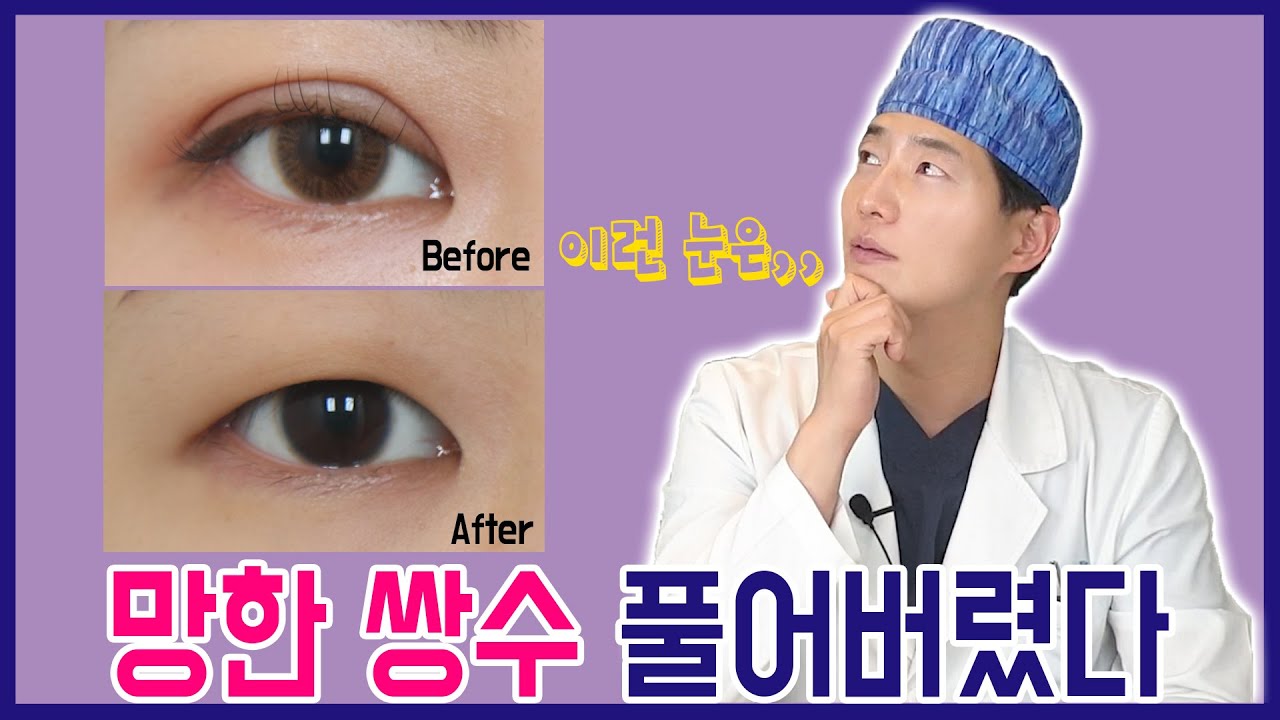[ENG/눈성형] 쌍꺼풀을 제거할 수 있나요?