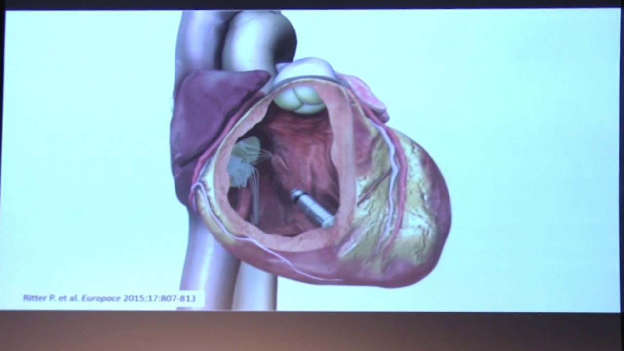 The Future of Device Therapy in ACHD - Dr. Jeremy Moore | 2017 UCLA ACHD Symposium