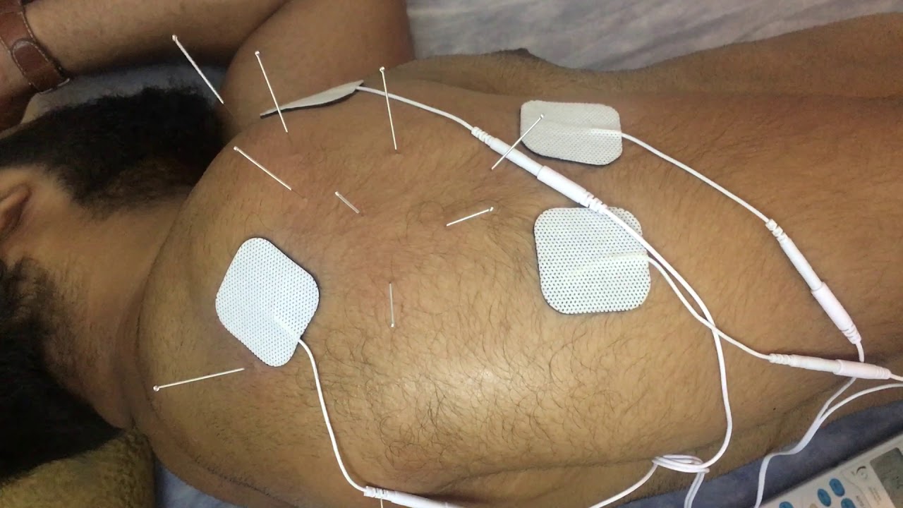 HPE Functional Dry Needling for Deltoid muscle (shoulder)