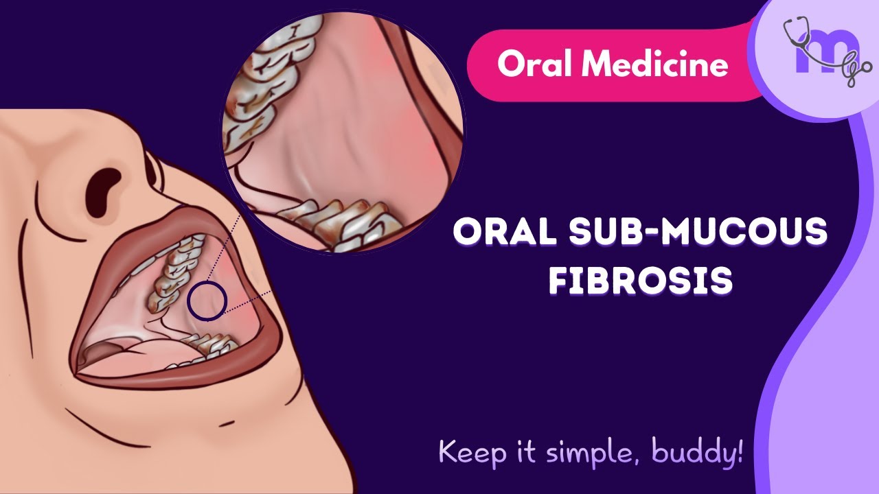 Oral Submucous Fibrosis (OSMF) | Clinical Features, Diagnosis & Management Explained