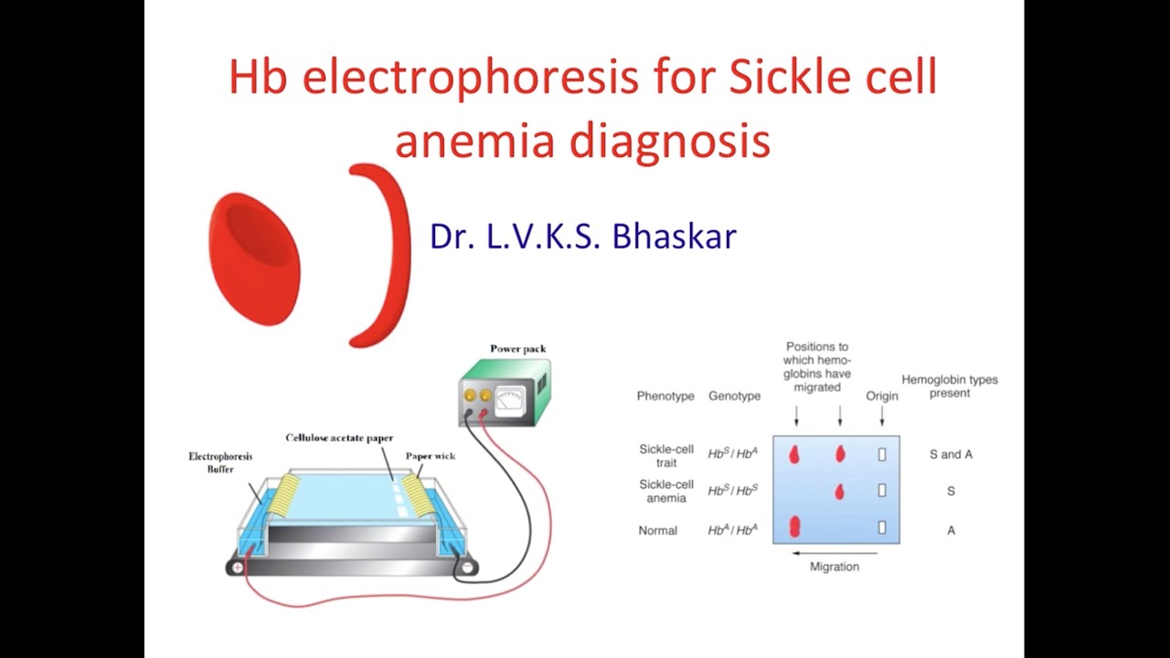Hb electrophoresis for sickle cell anemia /disease