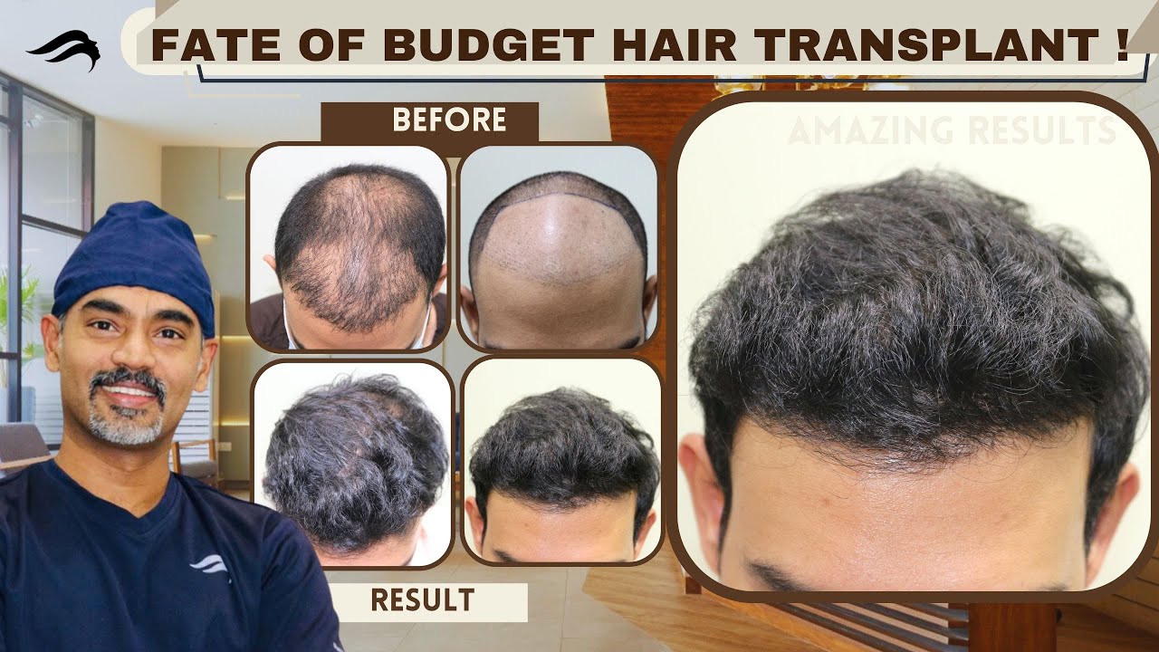 Hair Transplant In Bangalore | Best Doctor Cost & Clinic Of Hair Transplant In Bangalore