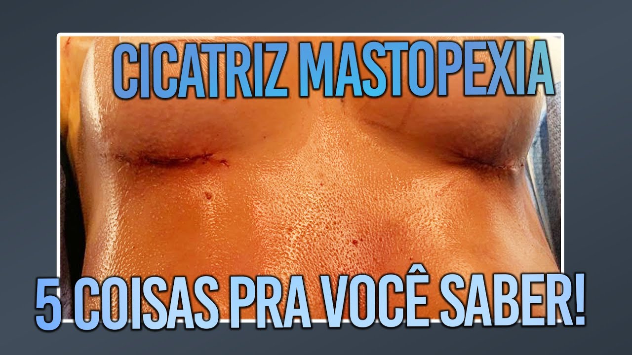 CICATRIZ DE MASTOPEXIA   5 PERGUNTAS QUE SEMPRE RECEBO I CIRURGIA PLÁSTICA