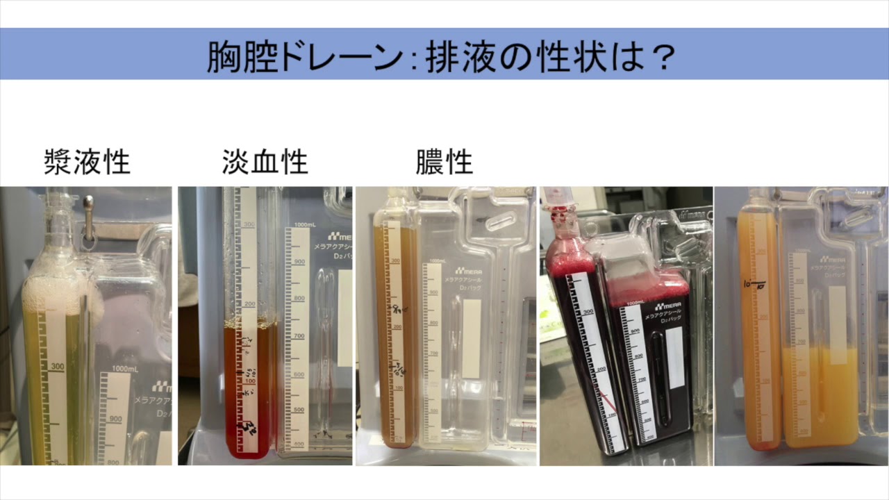 #001 胸腔ドレーン抜去の基準は？
