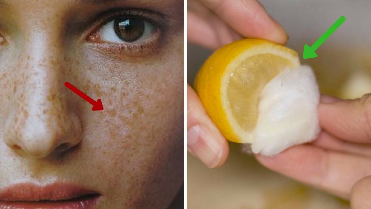 Want to Remove Freckles?  | Best Home Remedies to Get Rid of Freckles