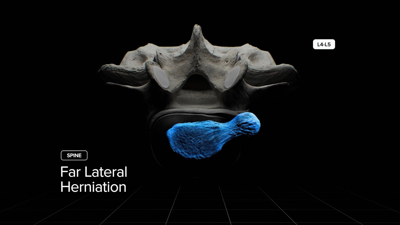 Voyage Into Kambin’s Prism - Far Lateral Herniation