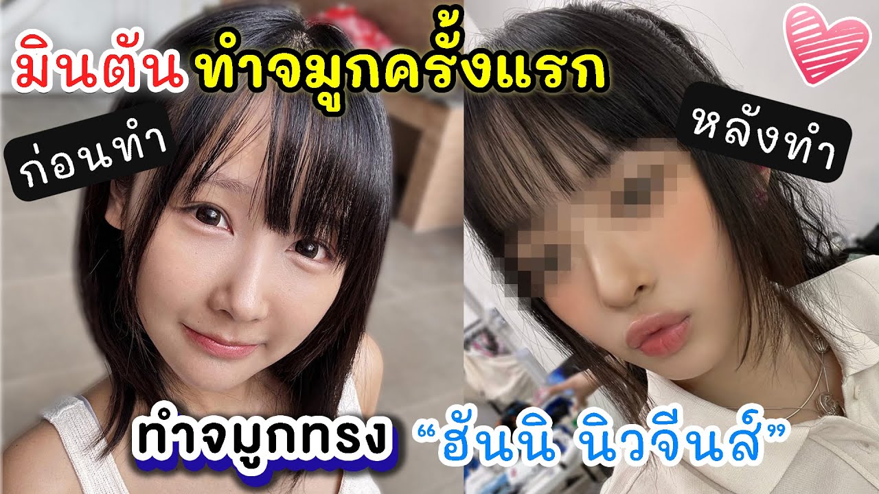 ขอสารภาพว่า~ แอบไปเสริมจมูก ทรง