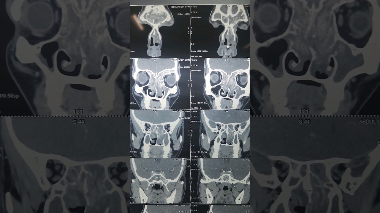 How Allergy to Fungus can Look like on CT SCAN.White is the FUNGUS seen within the Greyish Polyps