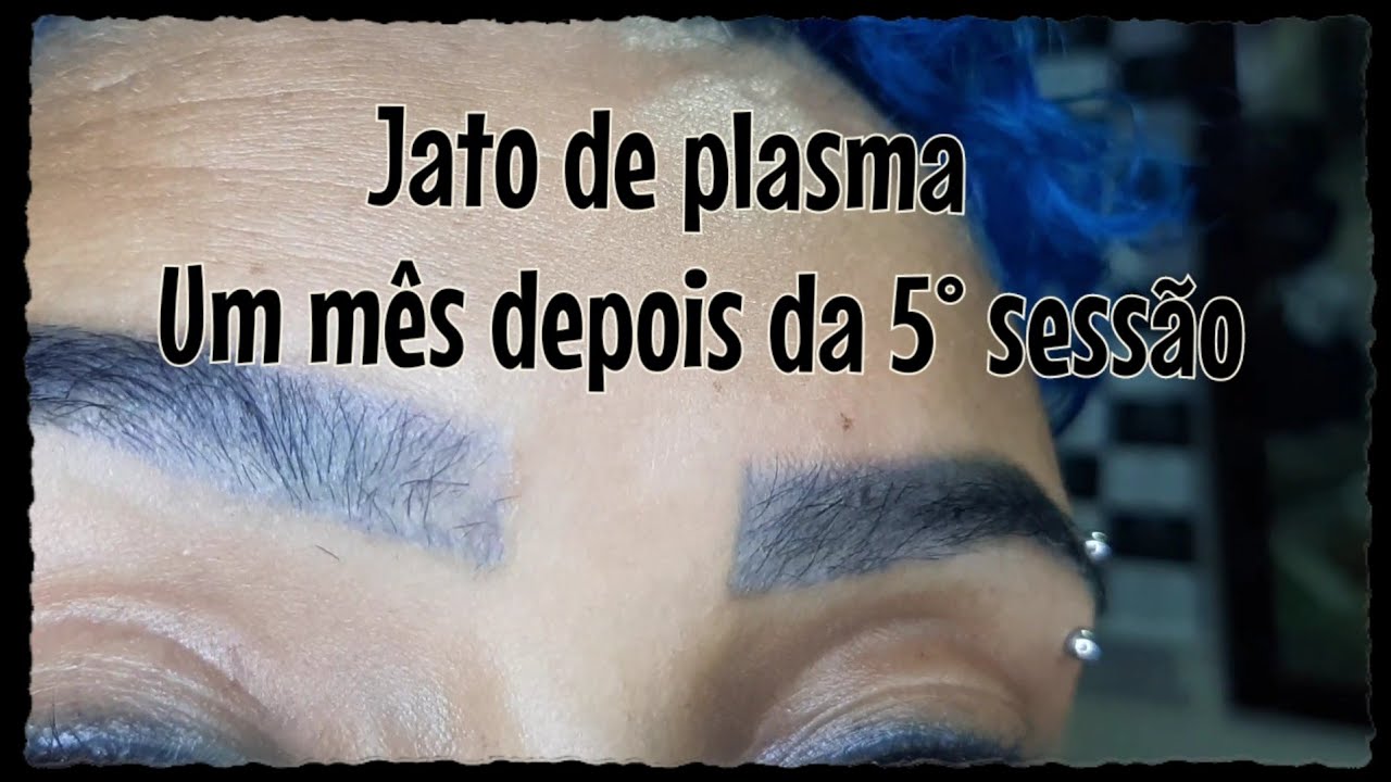Jato de plasma na sobrancelha um mês depois.