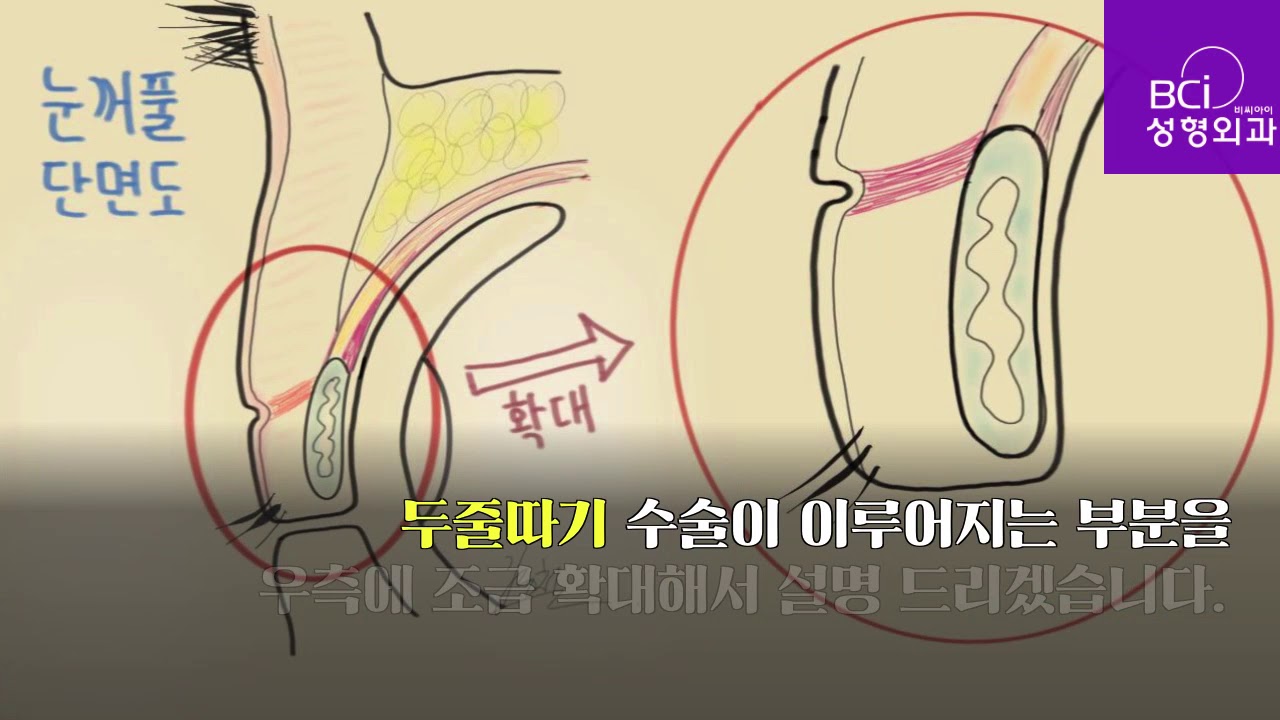 쌍꺼풀재수술(두줄따기) 동영상
