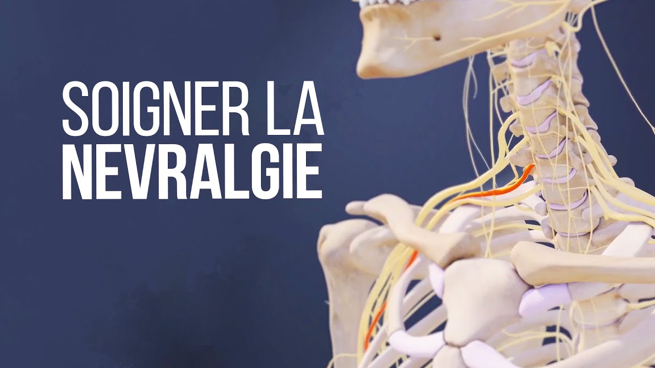 Douleurs nuque et fourmillement main:  STOP à la NÉVRALGIE CERVICO BRACHIALE