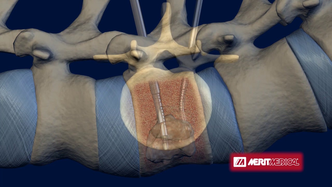 STAR™ Tumor Ablation System