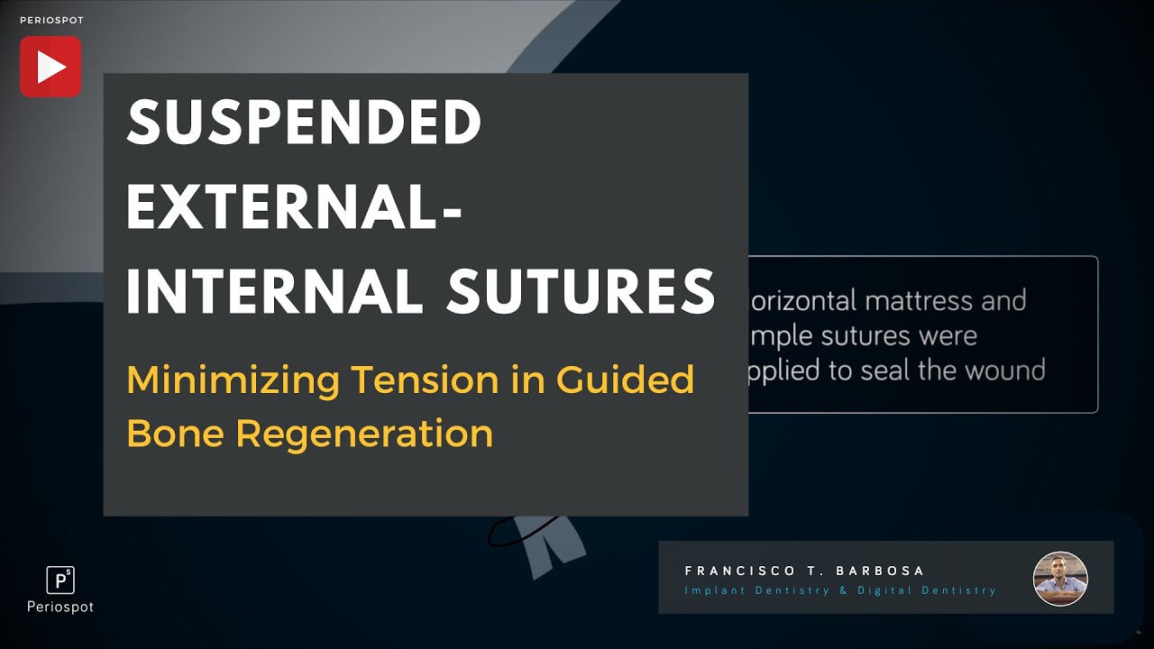 Suspended External-Internal Sutures: Minimizing Tension in Guided Bone Regeneration