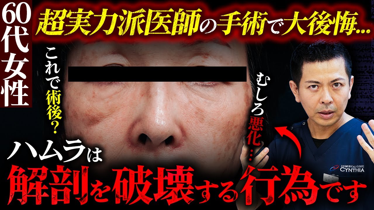 【60代女性】超実力派医師によるハムラで目の下がむしろ悪化！？クマ治療における"ハムラ"がいかに解剖を破壊する行為なのか解説します。