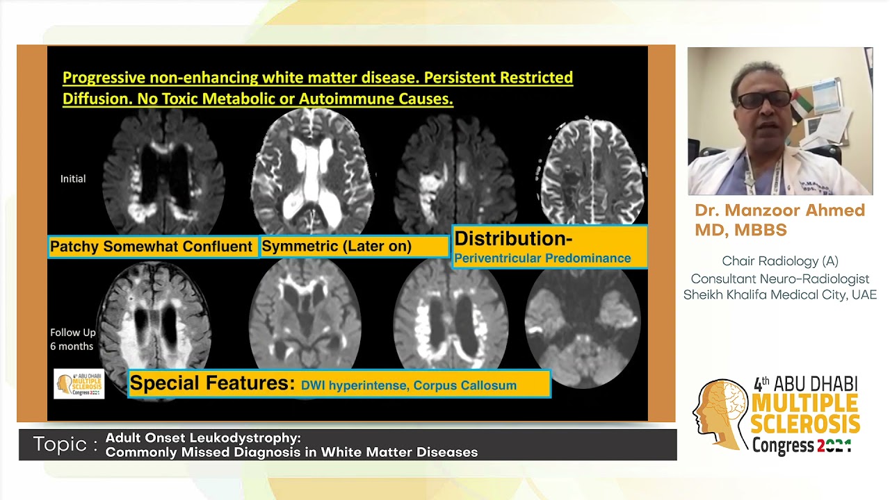 Dr. Manzoor Ahmed l Adult Onset Leukodystrophy