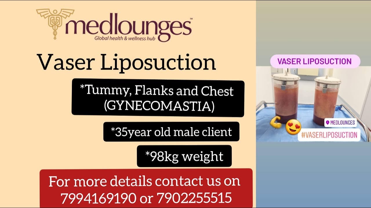 Vaser Liposuction @Medlounges #vaserlipo #singledayprocedure #lifelongresult