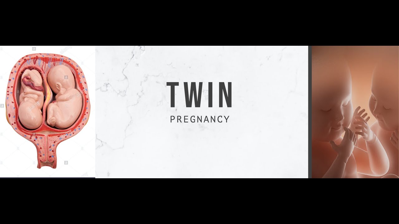 MULTIPLE PREGNANCY (Twin pregnancy)(Unit-7 OBG- HIGH RISK PREGNANCY)