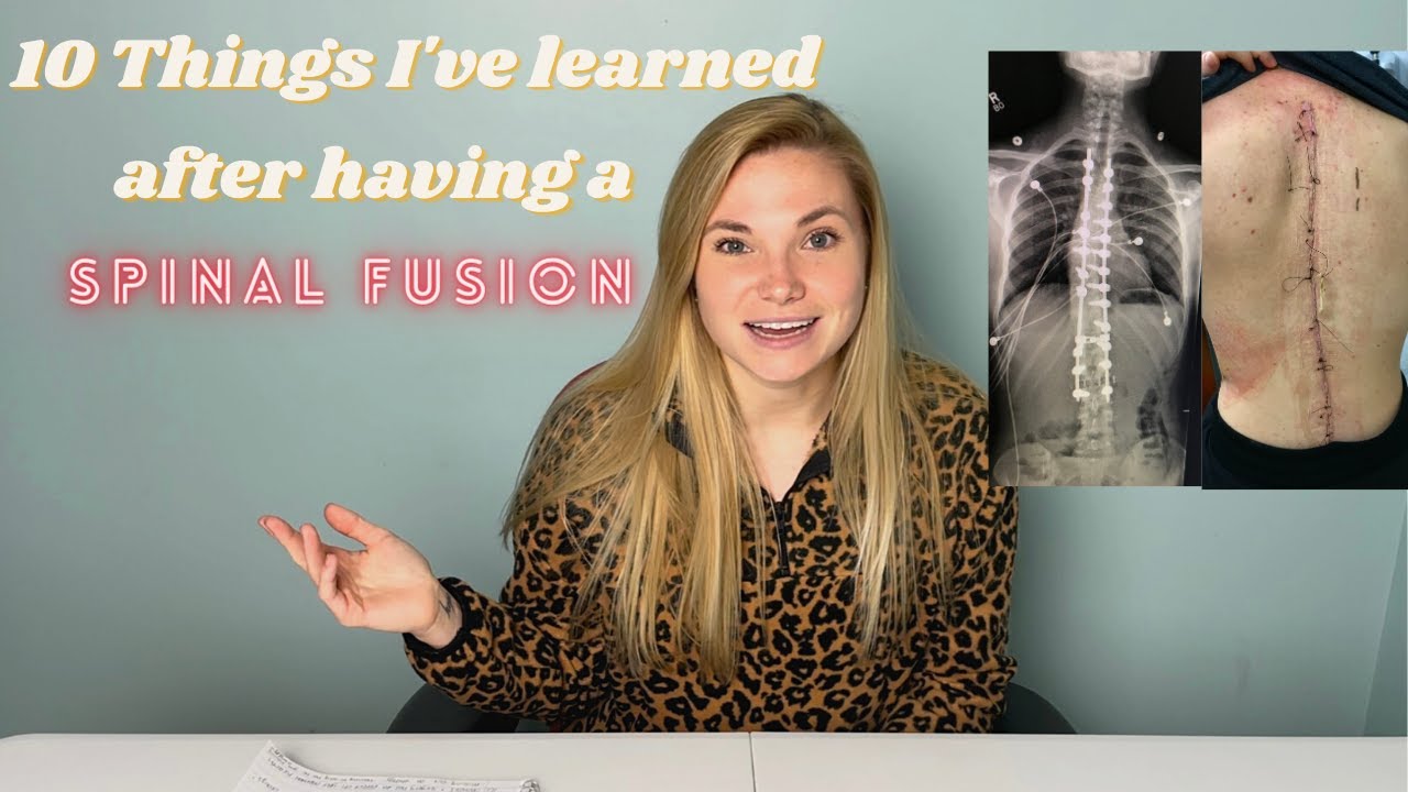 10 Things I've Learned After Undergoing Spinal Fusion Surgery | Scoliosis