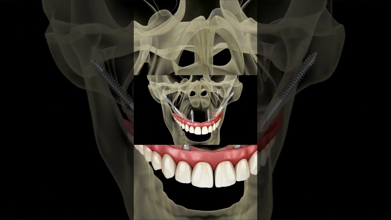 IMPLANTE ZIGOM&Aacute;TICO