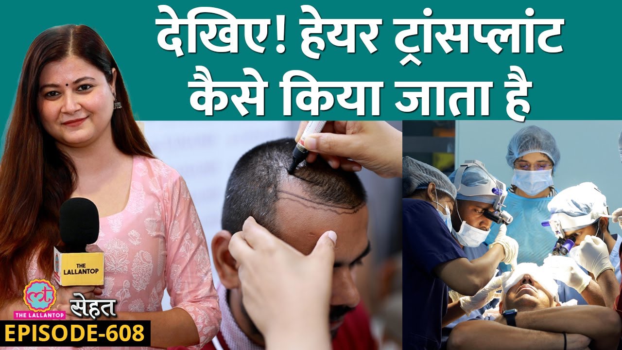 Hair Transplant के बाद बाल कभी नहीं गिरते, Baldness यानी गंजापन ठीक हो जाता है? | Sehat 608
