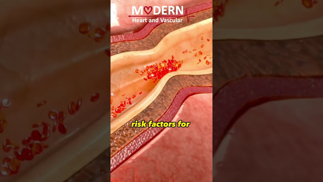 How Stress affects your Heart and Blood Vessels?