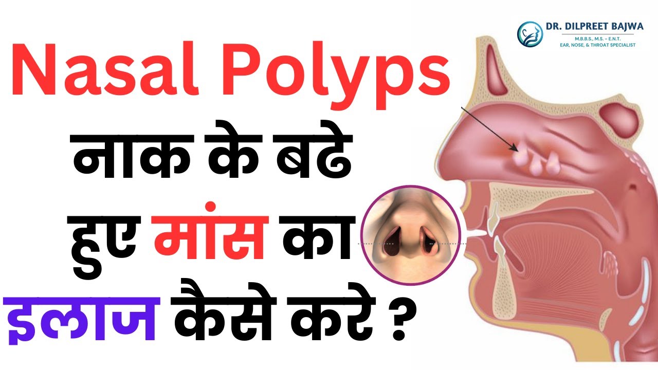Nasal Polyps - नाक के बढे हुए मांस का इलाज कैसे करे || Nasal Polyps Symptoms, Causes, Treatment