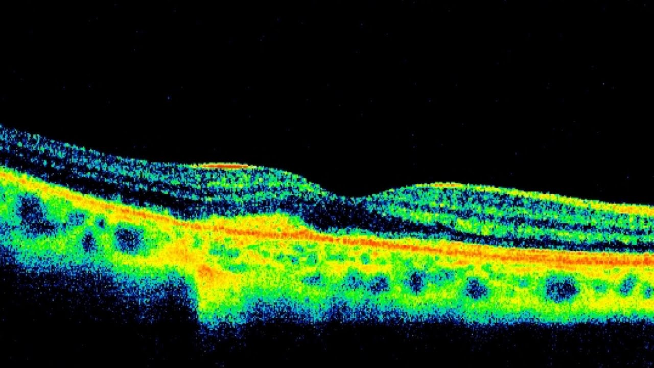 Choroidal Neovascularization