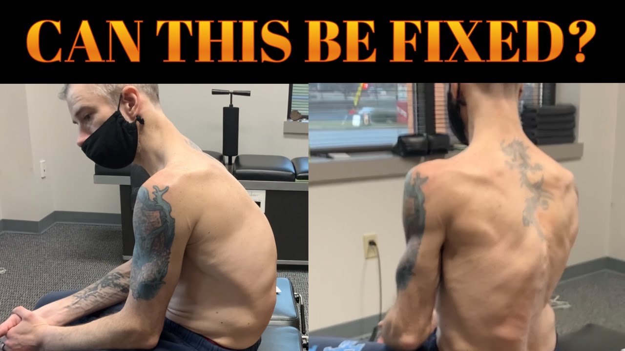 SEVERE Scoliosis + Kyphosis & Chiropractic. Former Power Lifter Suffers Career Ending Injury.