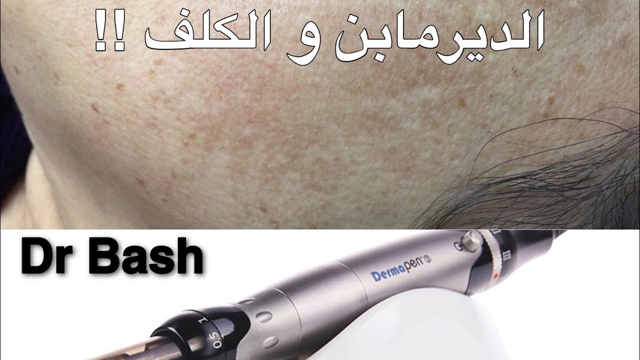 الديرمابن لعلاج الكلف ـ توصيات دكتور جلد و تجميل