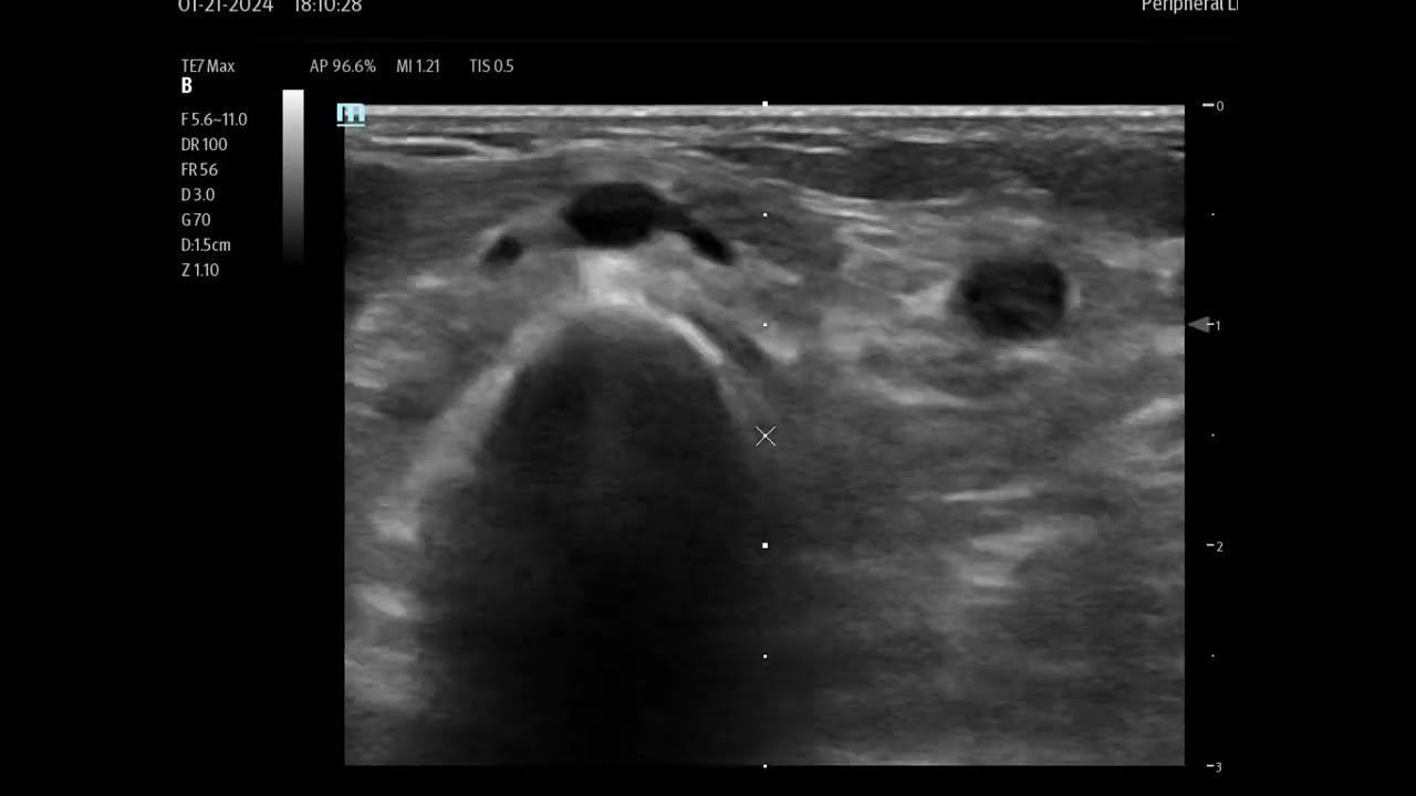 Ultrasound Guided IV Insertion Tips and Tricks (Understanding Sonographic Images).
