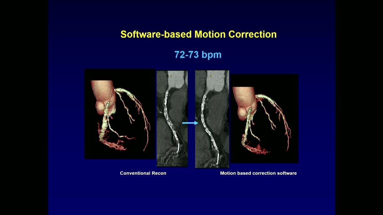 Sponsored Symposium | Changing the Beat in Cardiac Care with Advanced CT Technologies