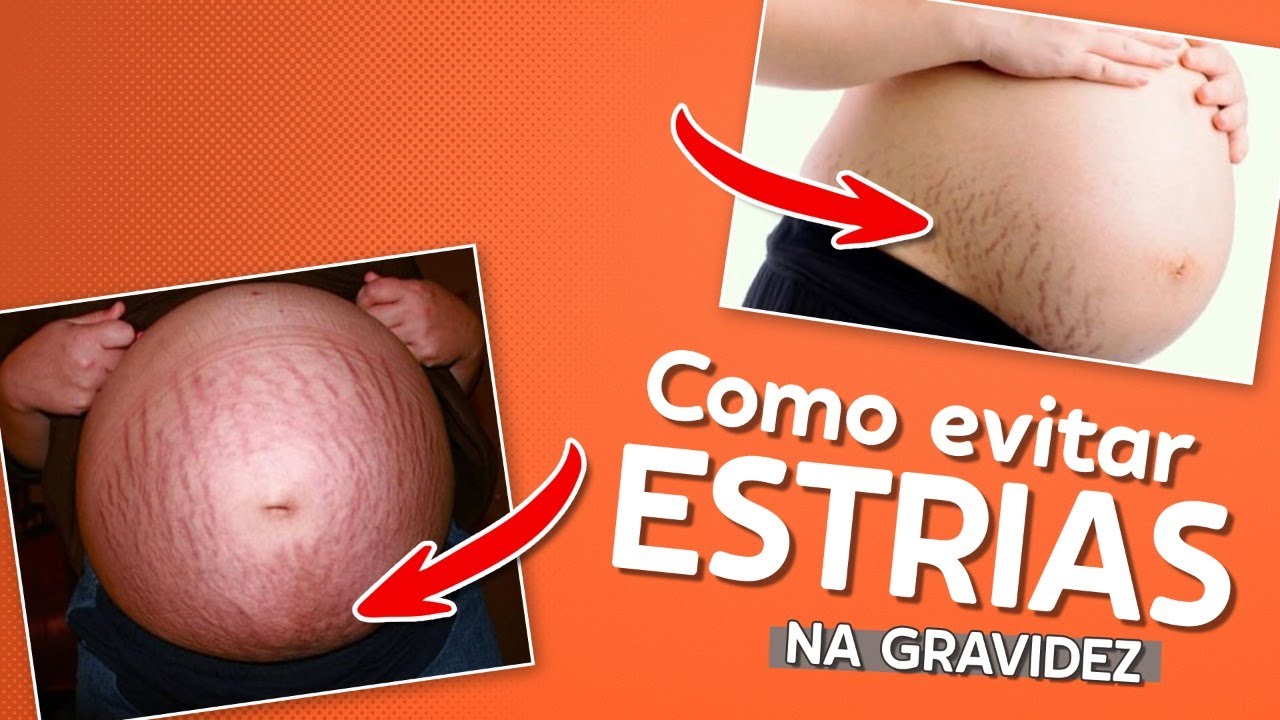Como evitar as Estrias na Gravidez?