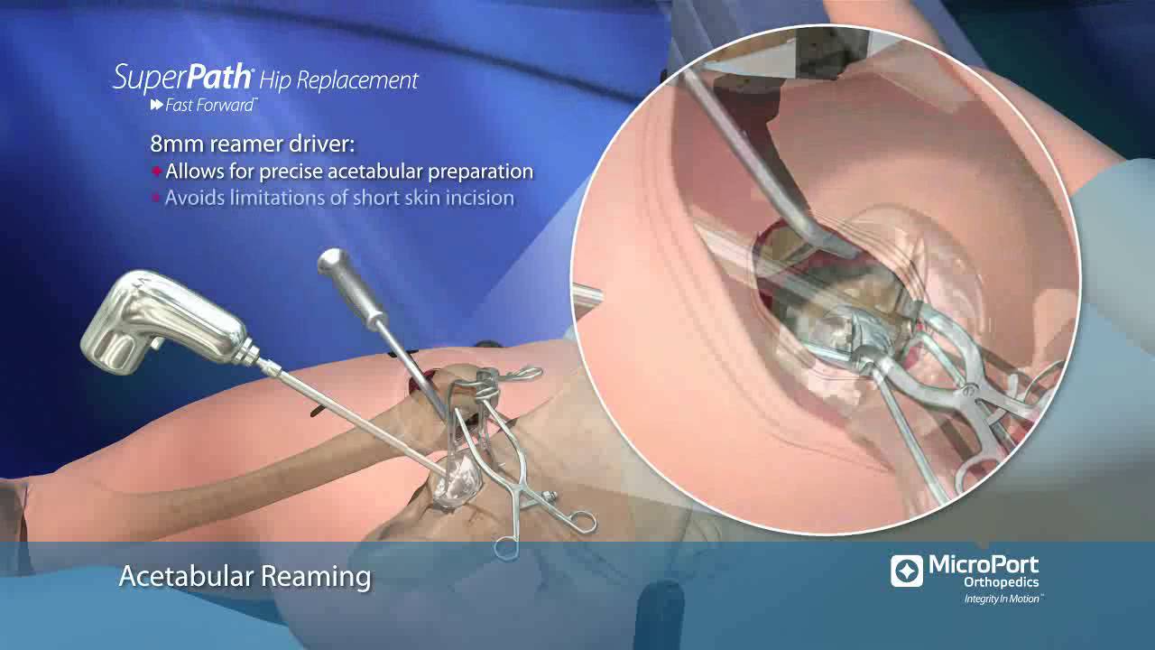 Особенности  хирургической  техники  SuperPath  (MicroPort Orthopedics)