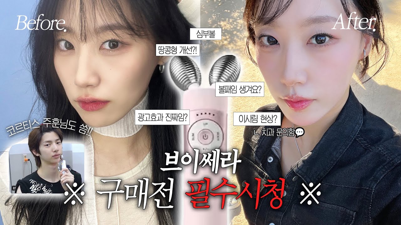 브이쎄라 내돈내산 4개월 후기💬(+이시림 치과문의)  | 장/단점 • Q&A • 추천/비추천대상